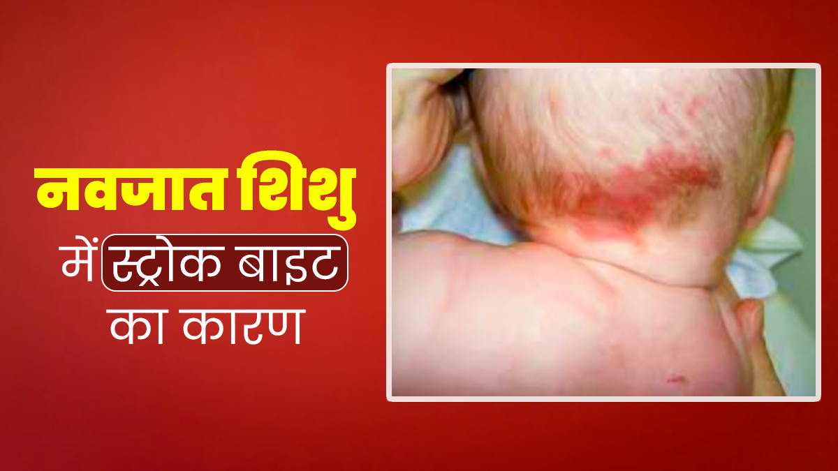 नवजात शिशु के गर्दन के पीछे लाल पैच हो सकता है स्ट्रोक बाइट, डॉक्टर से जानें इसके बारे में